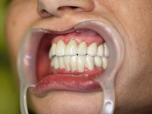 Lucrări din Full-Zirconia (oxid de Zirconiu) pe Implanturi Dentare