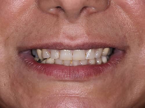 Dinți frontali închiși la culoare