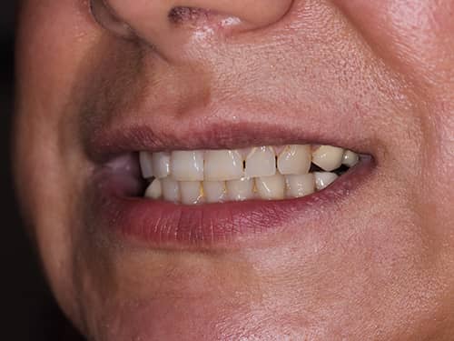 Dinți frontali închiși la culoare