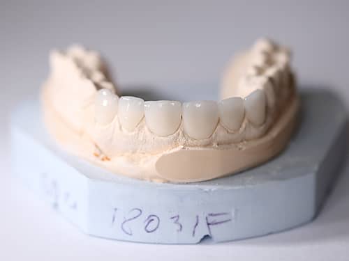 Fațete Dentare ceramice e-Max