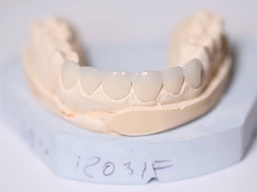 Fațete Dentare ceramice e-Max