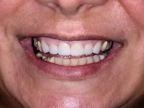 Fațete Dentare ceramice e-Max