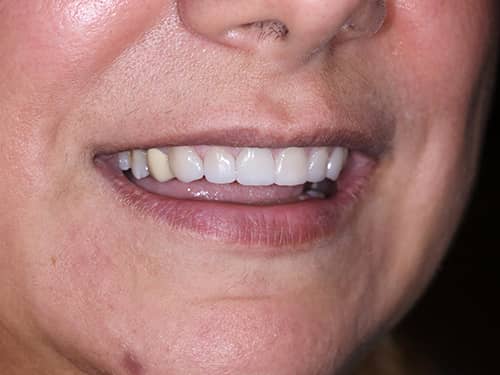 Fațete Dentare ceramice e-Max