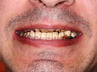 zâmbet inestetic - amelogenesis imperfecta