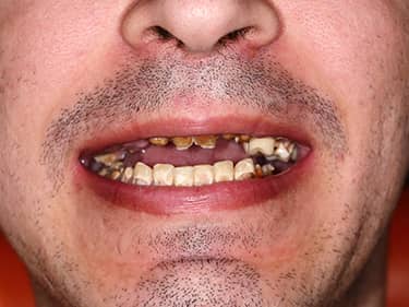 Zâmbet inestetic - amelogenesis imperfecta