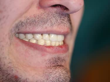 Coroane Dentare din Ceramică pe oxid de Zirconiu