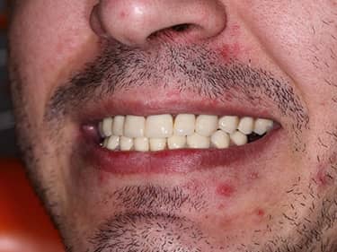 Coroane Dentare din Ceramică pe oxid de Zirconiu