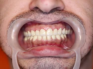 Coroane Dentare din Ceramică pe oxid de Zirconiu