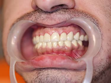 Coroane Dentare din Ceramică pe oxid de Zirconiu