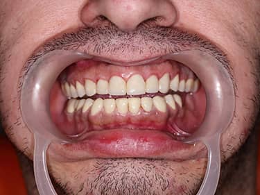 Coroane Dentare din Ceramică pe oxid de Zirconiu