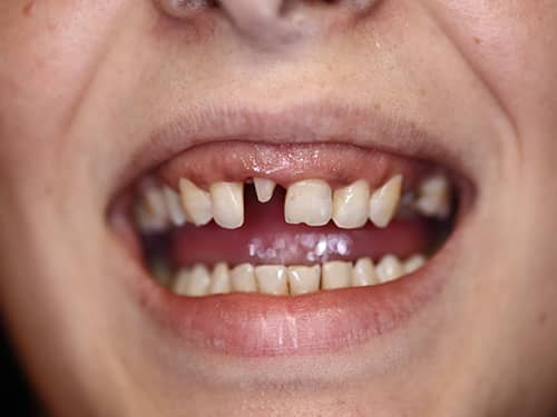 Dinte frontal preparat sub formă de bont pentru a fi acoperit cu o coroniță protetică