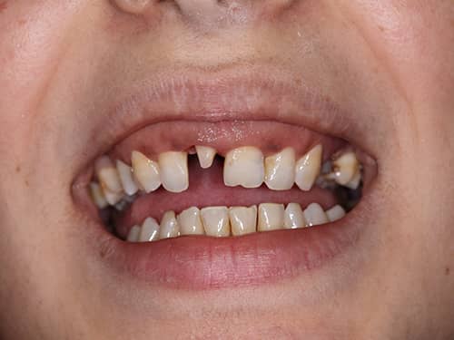 Dinte frontal preparat sub formă de bont pentru a fi acoperit cu o coroniță protetică