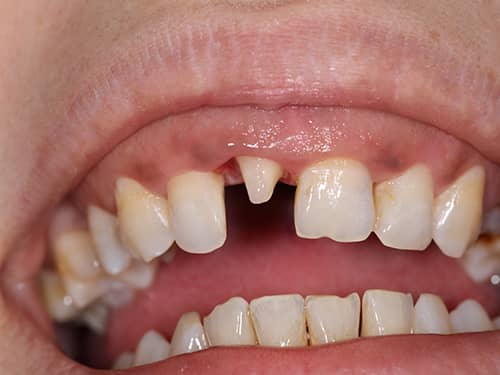 Dinte frontal preparat sub formă de bont pentru a fi acoperit cu o coroniță protetică