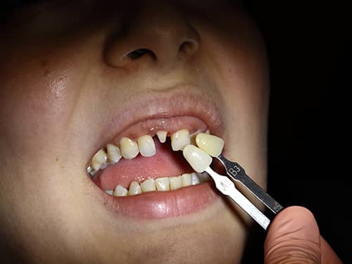 Dinte frontal preparat sub formă de bont pentru a fi acoperit cu o coroniță protetică