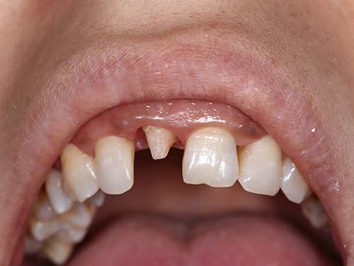 Dinte frontal preparat sub formă de bont pentru a fi acoperit cu o coroniță protetică