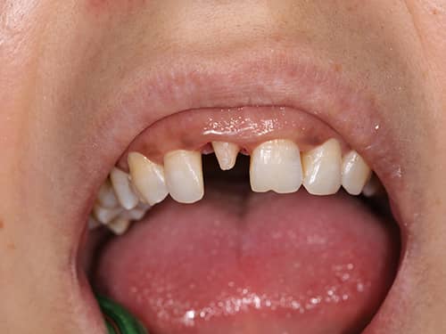 Dinte frontal preparat sub formă de bont pentru a fi acoperit cu o coroniță protetică