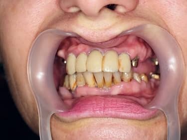 Lucrări protetice dentare vechi și inestetice