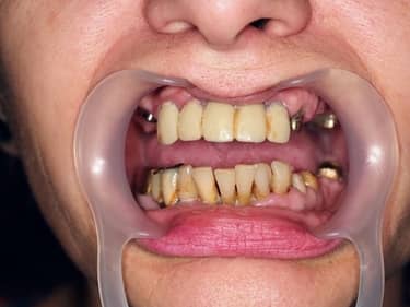 Dificultăți în masticație și estetică dentară