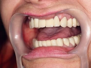 Coroane și Punți Dentare full-Zirconia