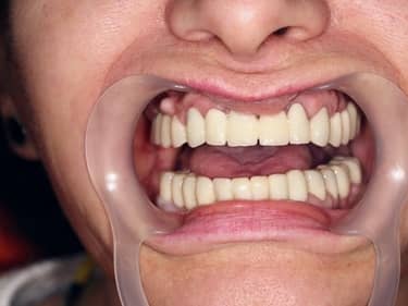 Coroane și Punți Dentare full-Zirconia