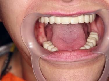 Coroane și Punți Dentare full-Zirconia