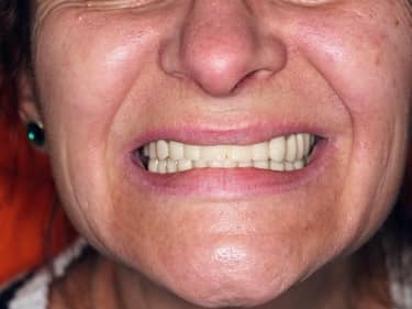 Coroane și Punți Dentare full-Zirconia