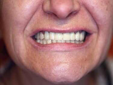 Coroane și Punți Dentare full-Zirconia