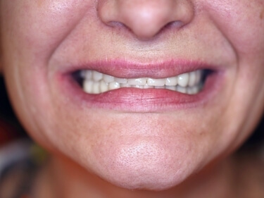 Armonia feței refacută