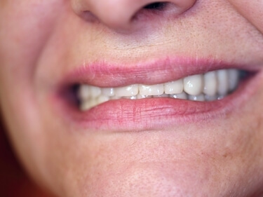 Armonia feței refacută